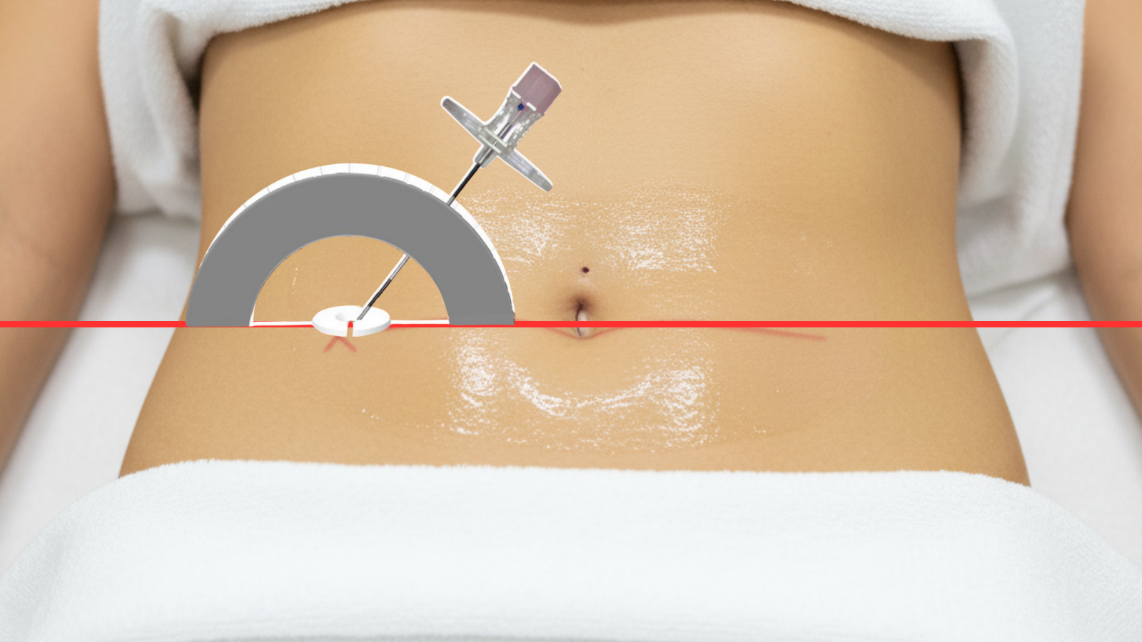 Step 3: Position needle